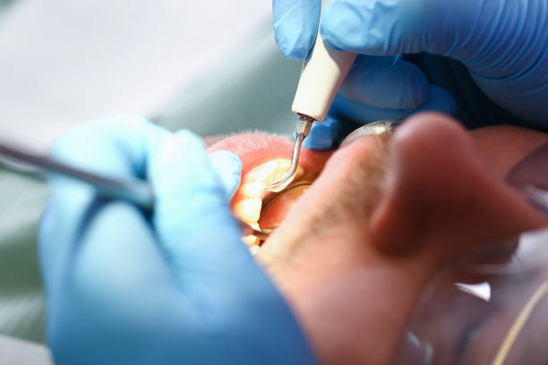 Best Emergency Treatment for Dental Infections or Abscesses in Port Byron, NY